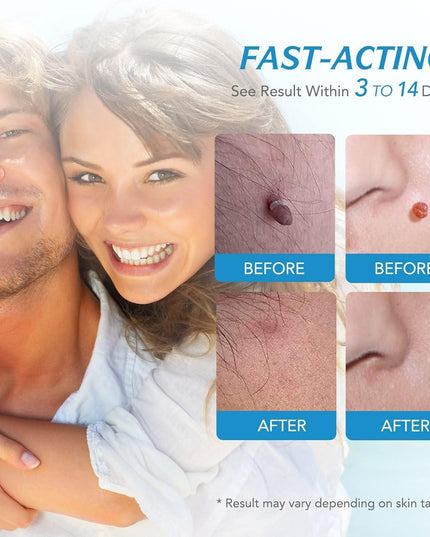 2 in 1 Skin Tag Remover Kit - Painless