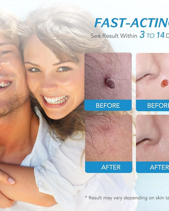 2 in 1 Skin Tag Remover Kit - Painless