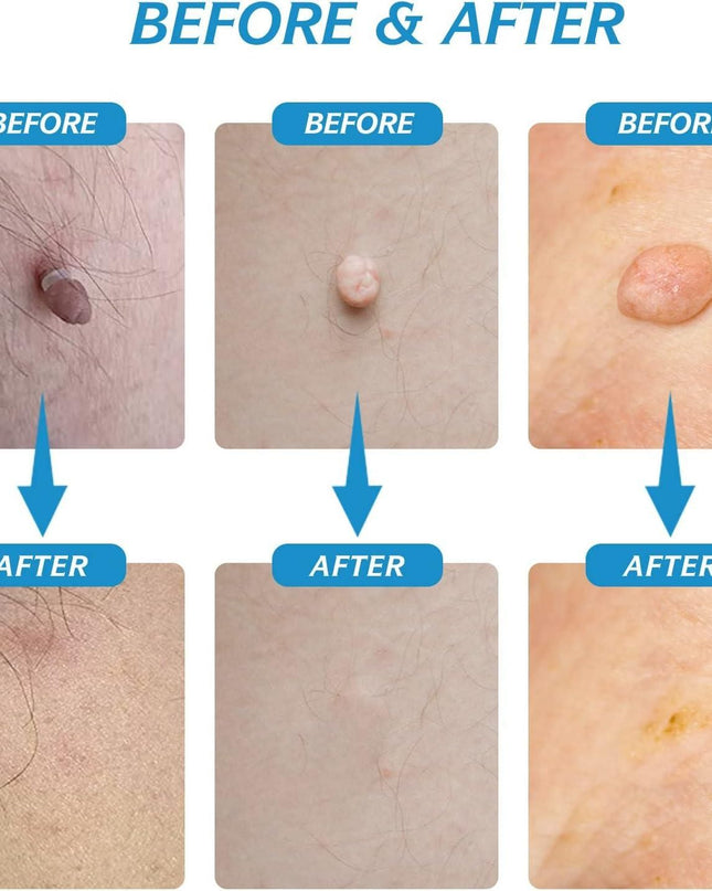 2 in 1 Skin Tag Remover Kit - Painless